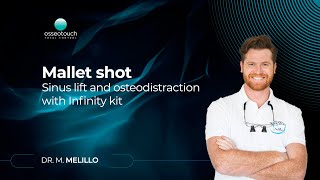 Mallet Shot: Sinus lift and osteodistraction with Infinity kit Dr Melillo