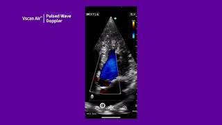 Vscan Air™ Tutorials | Pulsed Wave Doppler