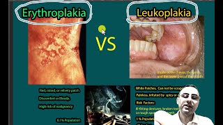 Erythroplakia Vs Leukoplakia; Symptoms, causes risk of malignancies