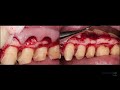 treatment of the mesial concavity of maxillary 1st bicuspids