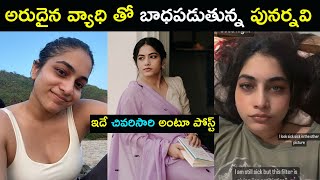 Actress Punarnavi suffering with Rare disease | Star Mantra