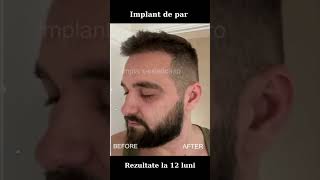 Before and after - Rezultate - implant de par 12 luni #implantpar #implantdepar #beforeandafter