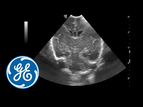 What does an ultrasound of head show?