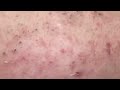 用手挤黑头就是爽#粉刺#blackheads