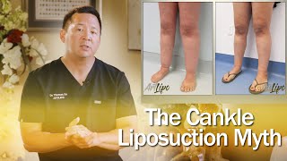 Lipedema Surgery | Cankle Liposuction | Expert Dr. Thomas Su | ArtLipo