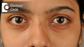 How to get rid of dark circles and hollow eyes? - Dr. Deepak P Devakar