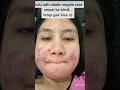 Cerita pengalaman berjuang melawan jerawat ada di youtube . #acne #jerawat