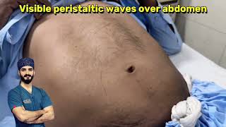 Visible Gut Peristalsis - Dr Tayyab Riaz Ch