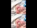 rf micro needling pigmentation scars wrinkles treatment