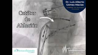 Ablación de arritmia cardiaca supraventricular - Dr Luis Gómez