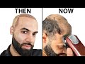 I Shaved My HEAD BALD 4 Years After Hair Transplant | Surgeon Reacts