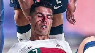 Ronaldo broke his nose vs Czech Republic
