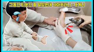 그동안 티눈인 줄 알았는데 사마귀라고 해서 놀랬어요! 바로 병원으로 가서 치료를 했어요 근데 아직도 여러번 병원에 가서 치료를 해야 해요 [사랑아놀자 LOVE\u0026TORY]