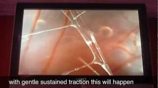 Fascia Magnified 25x (Subtitled)