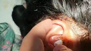 చెవి ఆపరేషన్ తరవాత జాగ్రత్తలు - Ear care for patient