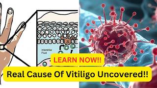 #Vitiligo Treatment: New Research Uncovers Key Mechanism | Linked to Skin Membrane Disruption