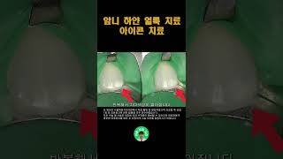 앞니에 하얀 얼룩 삭제없이 아이콘 치료! #치과의사 #치과