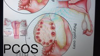 polycystic Ovary Syndrome/Cause/Diganos/treatment