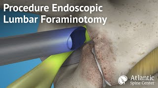 Procedure Endoscopic Lumbar Foraminotomy