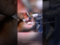 Chin Reduction In The OR: Patience Is The Key!