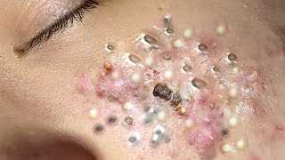 Big Cystic Acne Blackheads Extraction Blackheads \u0026 Milia, Whiteheads Removal Pimple Popping # 1699