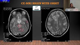 AIOCMT3 2024   GP42 topic   Dr Ritika singh A rare presentation of neurocysticercosis in young femal