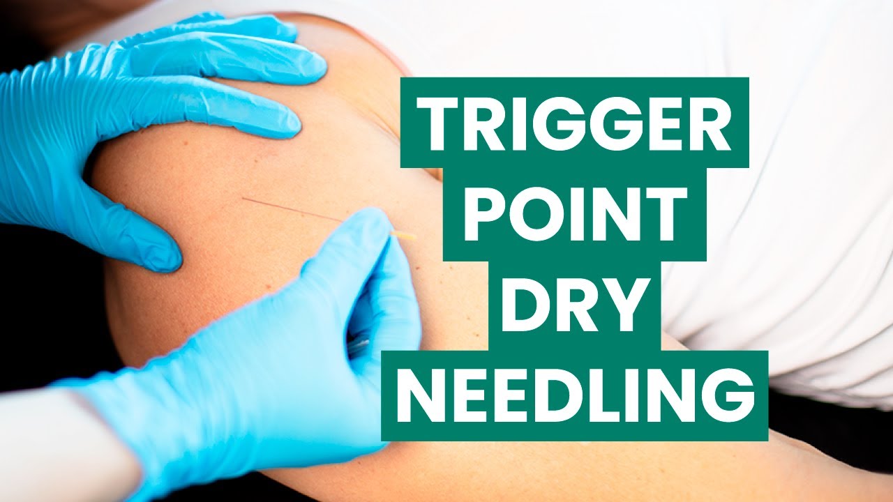 Trigger Point Dry Needling (TDN) | Foothills Sports Medicine Physical ...