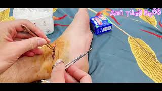 Cắt chỉ vết thương tại nhà | Cut the suture wound at home, so easy | Đơn giản với Anh Tùng 5566