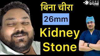 बिना चीरा 26mm का  Kidney Stone निकला | Laser kidney Stone Treatment | RIRS - 2.6 cm Stone Removal