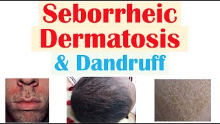 Seborrheic Dermatitis (Dandruff and Cradle Cap) Causes, Risk Factors, Symptoms, Diagnosis, Treatment