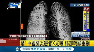 中國肺炎患者X光照片曝光...肺部明顯重創！ 義大利報紙訃聞\