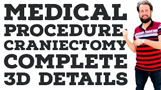 Medical procedure/ craniectomy procedure /3D animation with explanation