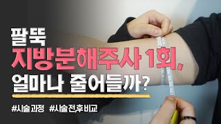 팔 지방분해주사 시술 전/후 비교! 1회 만으로 이 만큼 줄었다?(시술과정 포함)