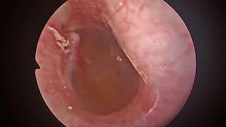 endoscopic myringotomy,ent