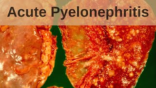 Acute pyelonephritis - Pathology mini tutorial