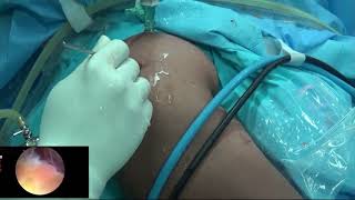 Rotator cuff repair for large tear, in double row by Dr Sujit Jos