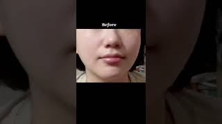 38세_팔자주름 평평하게 쉽고빠른 마사지, Nasolabial folds massage