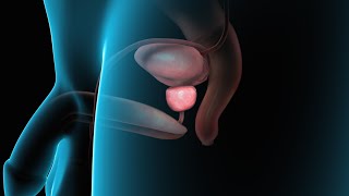 Enlarged Prostate (BPH)