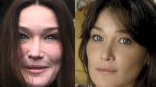 Carla Bruni Before and After Plastic Surgery
