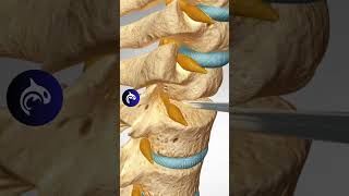 See how a Spinal Fusion Surgery (ACDF) works - 3D Animation