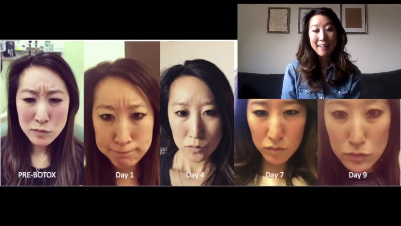 Botox Faq S Youtube