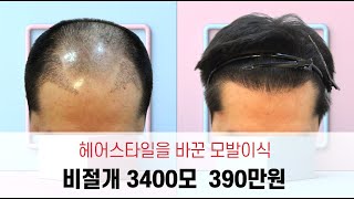 비절개모발이식 비용 3400모 390만원 (한시적비용)헤어스타일이 달라집니다.