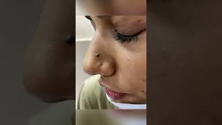 Mole Removal in Chandigarh |Dermatologist in Chandigarh | Dr Ashima Goel #shorts|how to remove moles