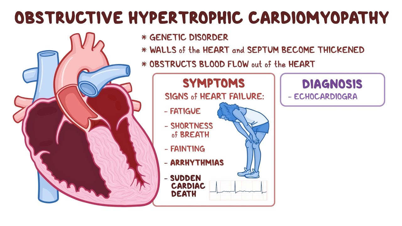 Hypertrophic Cardiomyopathy Explained Symptoms Causes Treatments