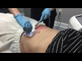 truSculpt - For Non-Invasive Fat Reduction & Skin Tightening