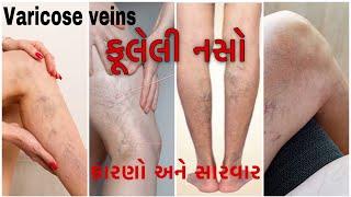 પગની નસ ફૂલી જવી varicose veins per ki nas ful jana exercise treatment સારવાર