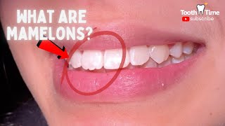 What are mamelons? do you need to fix them? Tooth Time Family Dentistry New Braunfels