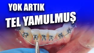 Ortodontide Stripping Nasıl Yapılır? Çapraşık Dişleri Düzeltme Yöntemi