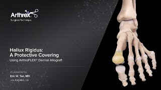 Hallux Rigidus: A Protective Covering Using ArthroFLEX® Dermal Allograft