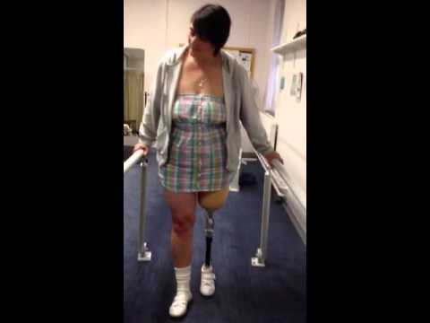 Tania's First Steps After Amputation Of Left Leg - YouTube